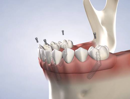 Learn about full-arch restoration at Foster City Oral Surgery Specialists