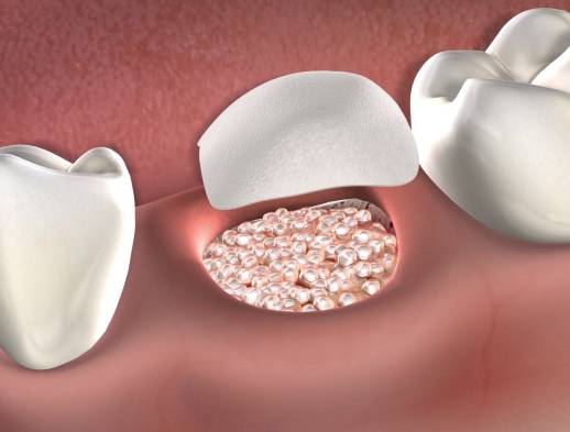 Learn about bone grafting at Foster City Oral Surgery Specialists