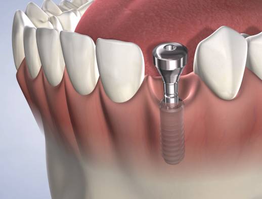 Learn about dental implants at Foster City Oral Surgery Specialists