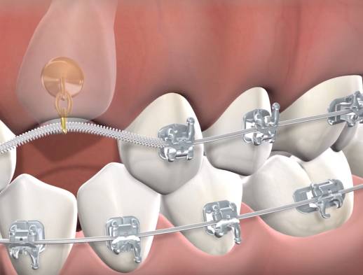 Learn about impacted canines at Foster City Oral Surgery Specialists