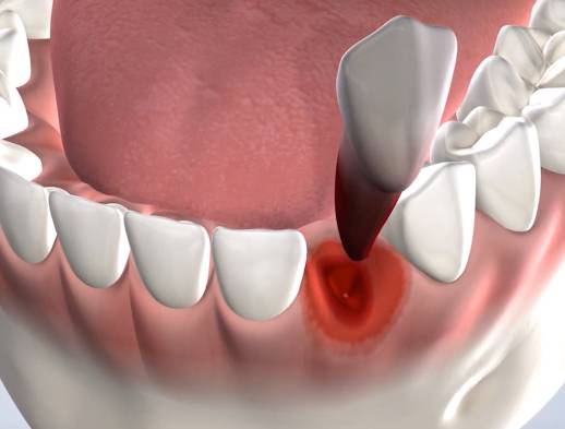 Learn about tooth extraction at Foster City Oral Surgery Specialists